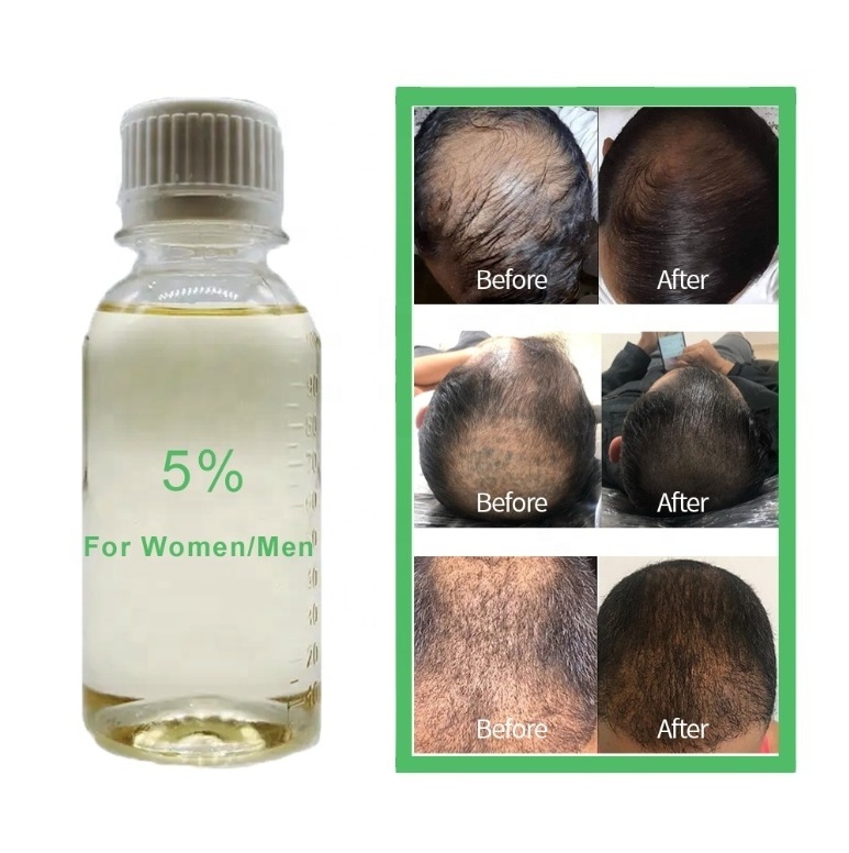 Anti Hair Loss OEM ODM kirkla 5% 60ml Private Label Hair Care Hair Growth Oil