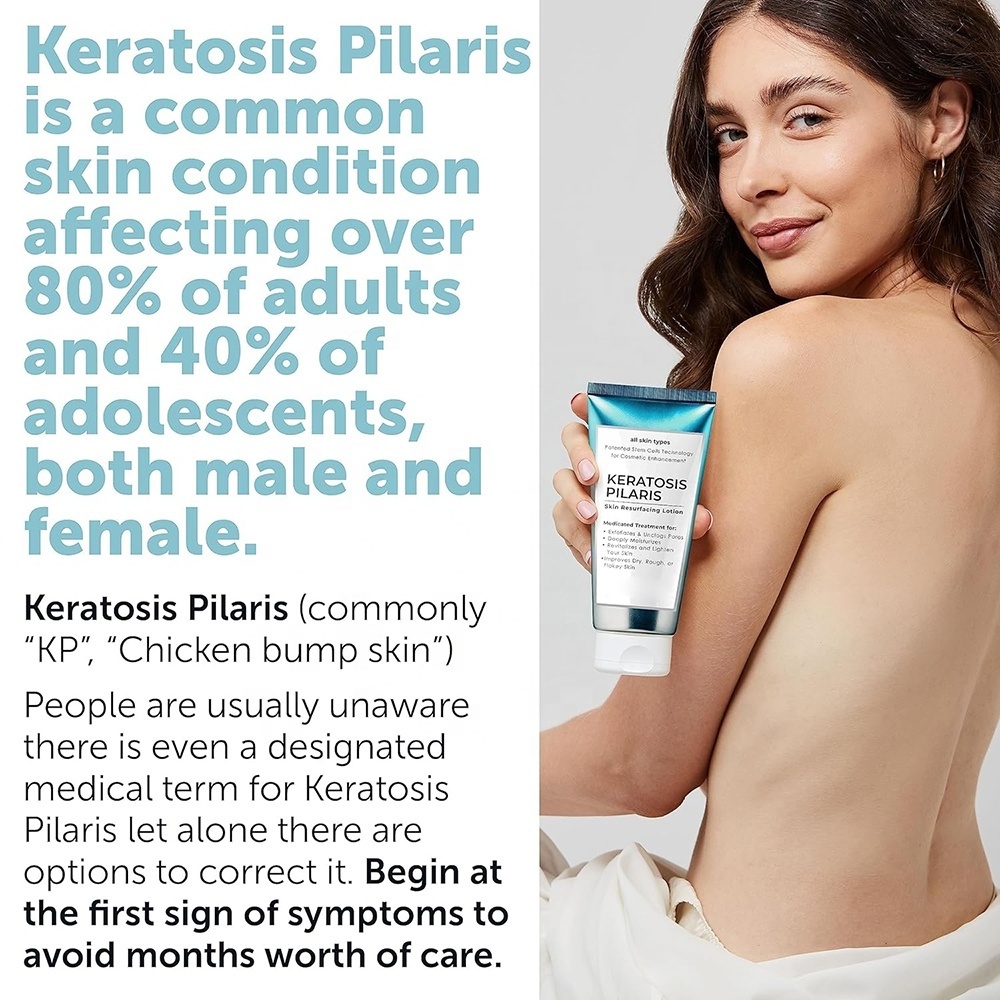 KP Keratosis Pilaris Treatment KP Bump Eraser Hydrating lotion Moisturizing and exfoliating lotion For Rough and Bumpy Dry Skin