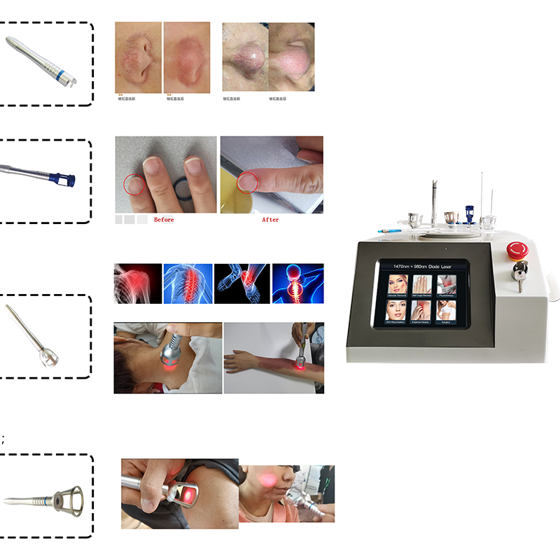 Factory price 980nm 1470 nm diode Laser Laser Machine Diode Laser Fat Reduce Machine