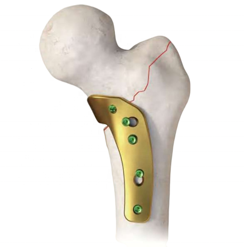 Proximal Femoral Locking Plate Triangular Buttress Implant for Trauma Fixation