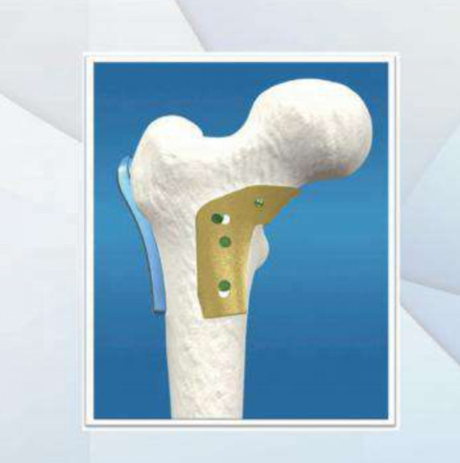 Proximal Femoral Locking Plate Triangular Buttress Implant for Trauma Fixation