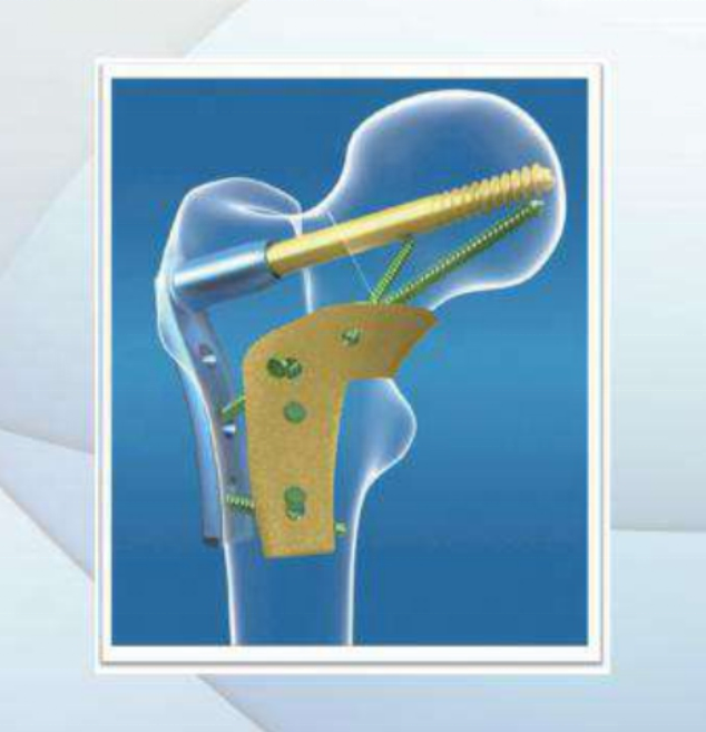 Proximal Femoral Locking Plate Triangular Buttress Implant for Trauma Fixation