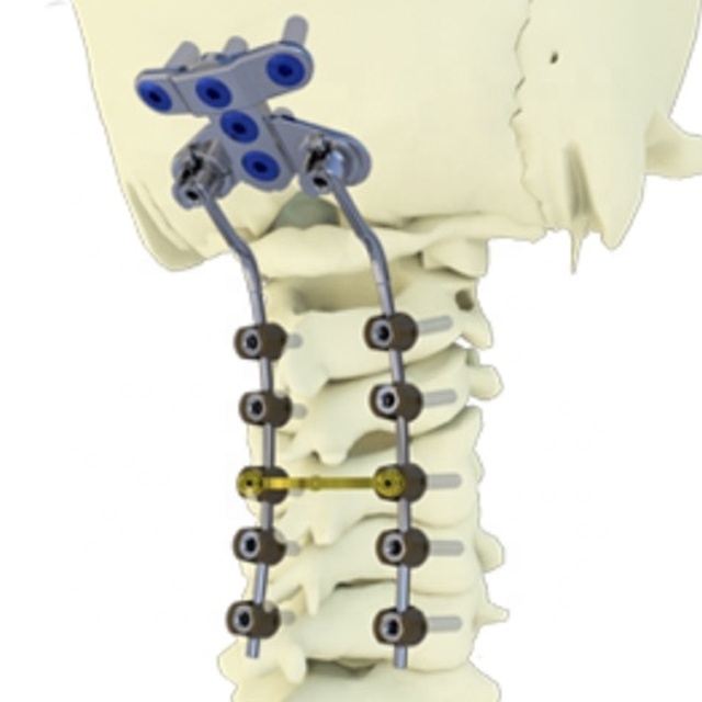 High quality Spinal Fixation System - Occipito-Cervico-Thoracic