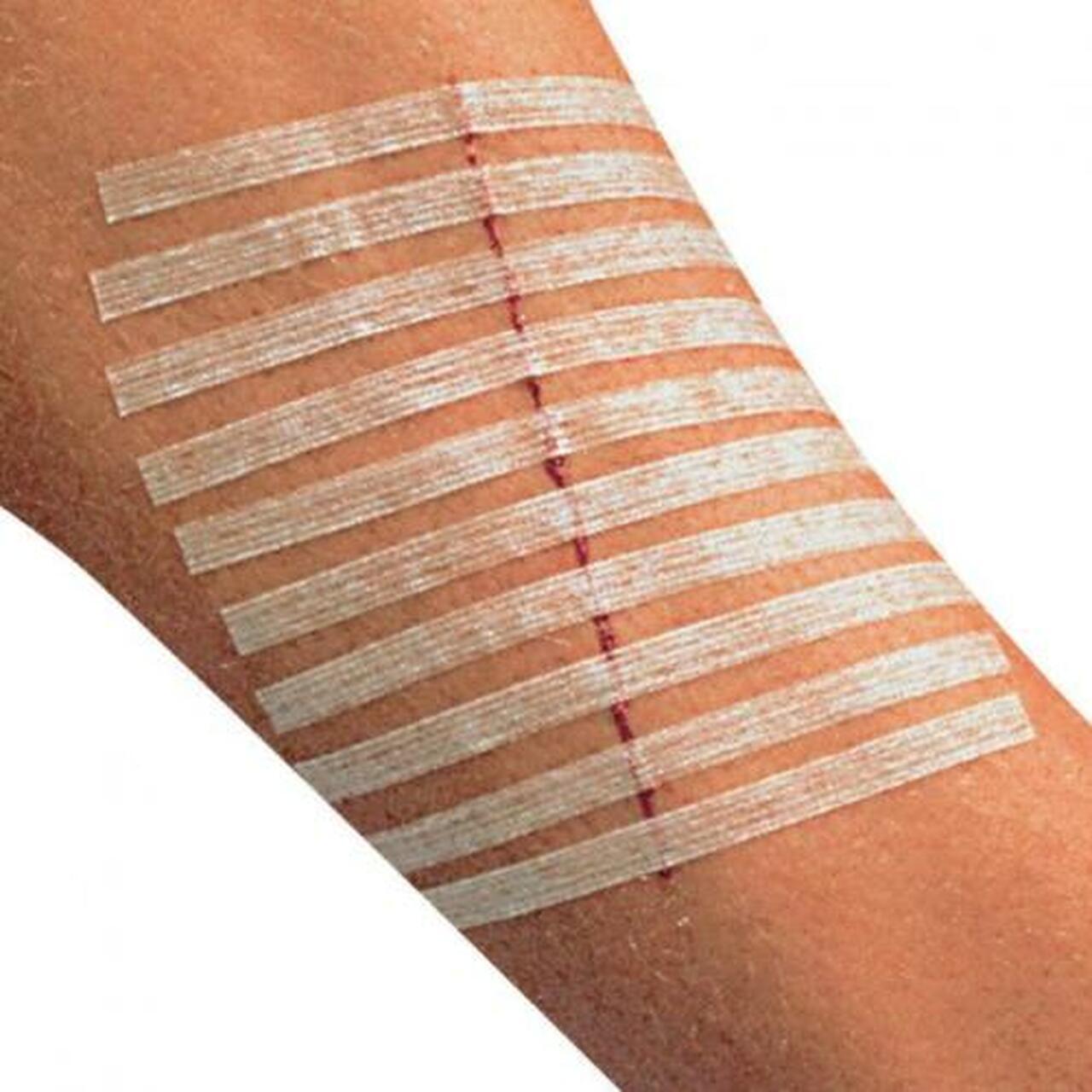 Home use adhesive zipstitch wound skin closure strip tape wound closure strips