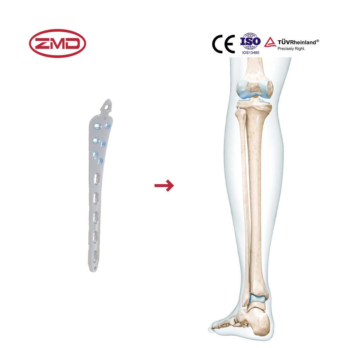 High Quality Factory Combination Holes Bone For Implant Multi-Axial Tibia Distal Medial Locking Plate