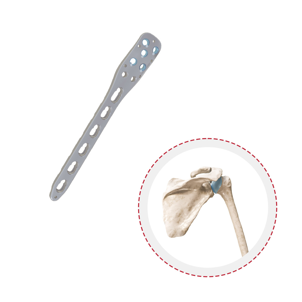 New Model Orthopedic Combination Holes Bone For Implant Multi-Axial Humeral Proximal Locking Plate