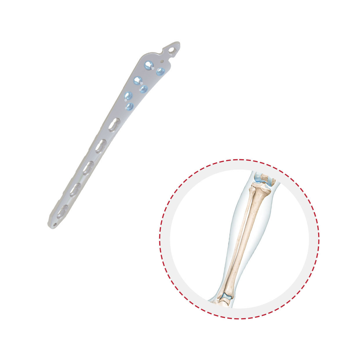 High Quality Factory Combination Holes Bone For Implant Multi-Axial Tibia Distal Medial Locking Plate