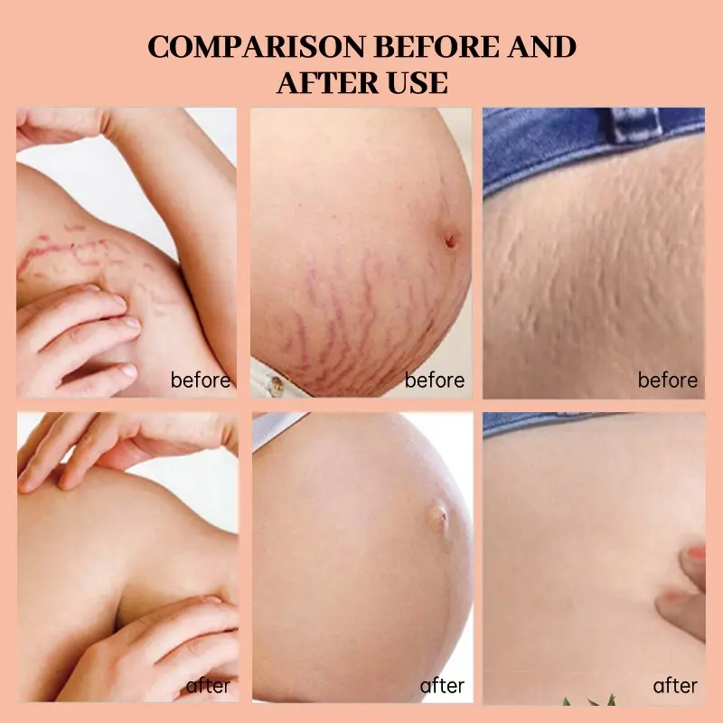 youth dairy stretch marks essential oils cream scar oil 100% natural pure  plant extract 7 days stretch mark removal oil