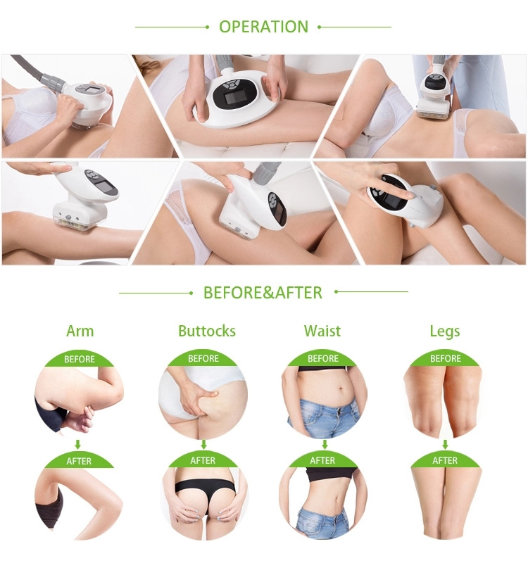 V shape Maquinas de Cavitation y Radiofrecuencia RF Lipocavitation Vaser Liposuction Vacuum Cavitation System Starvac MACHINE