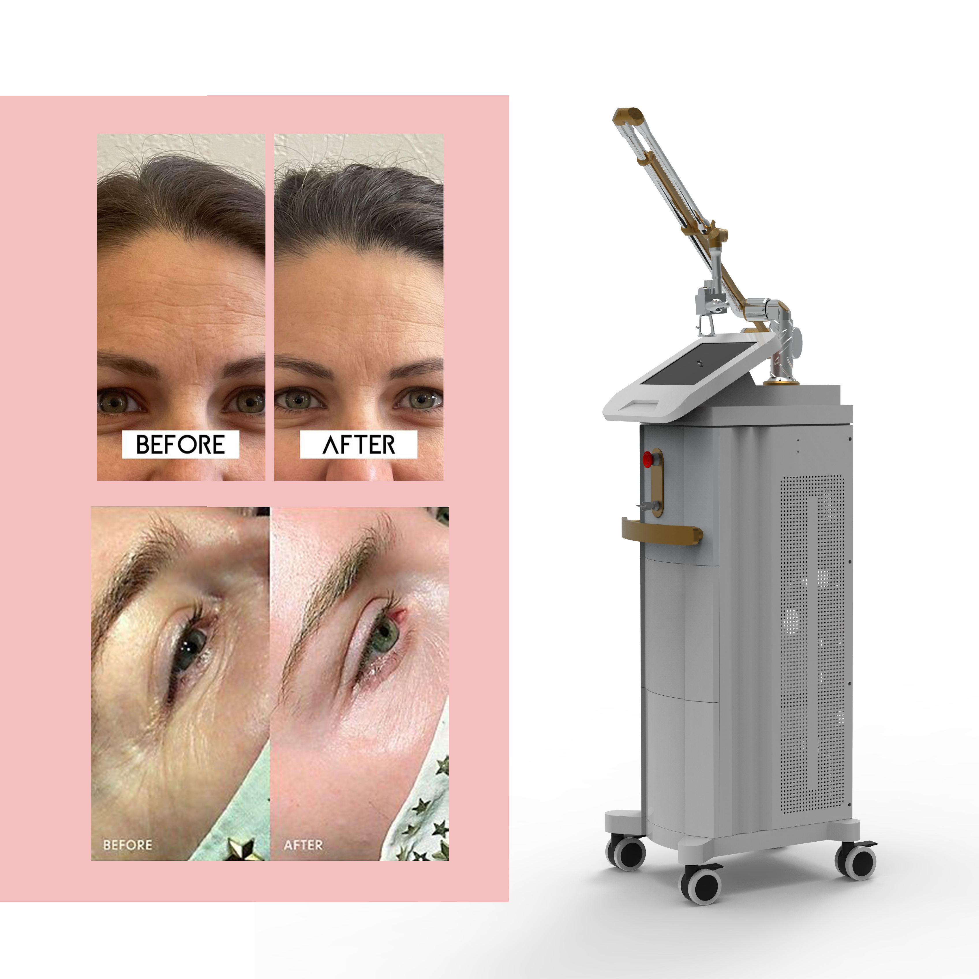 KM Laser Korea TUBE 10600nm Fractional Co2 Laser Acne removal Skin rejuvenation co2 fractional laser with TUV