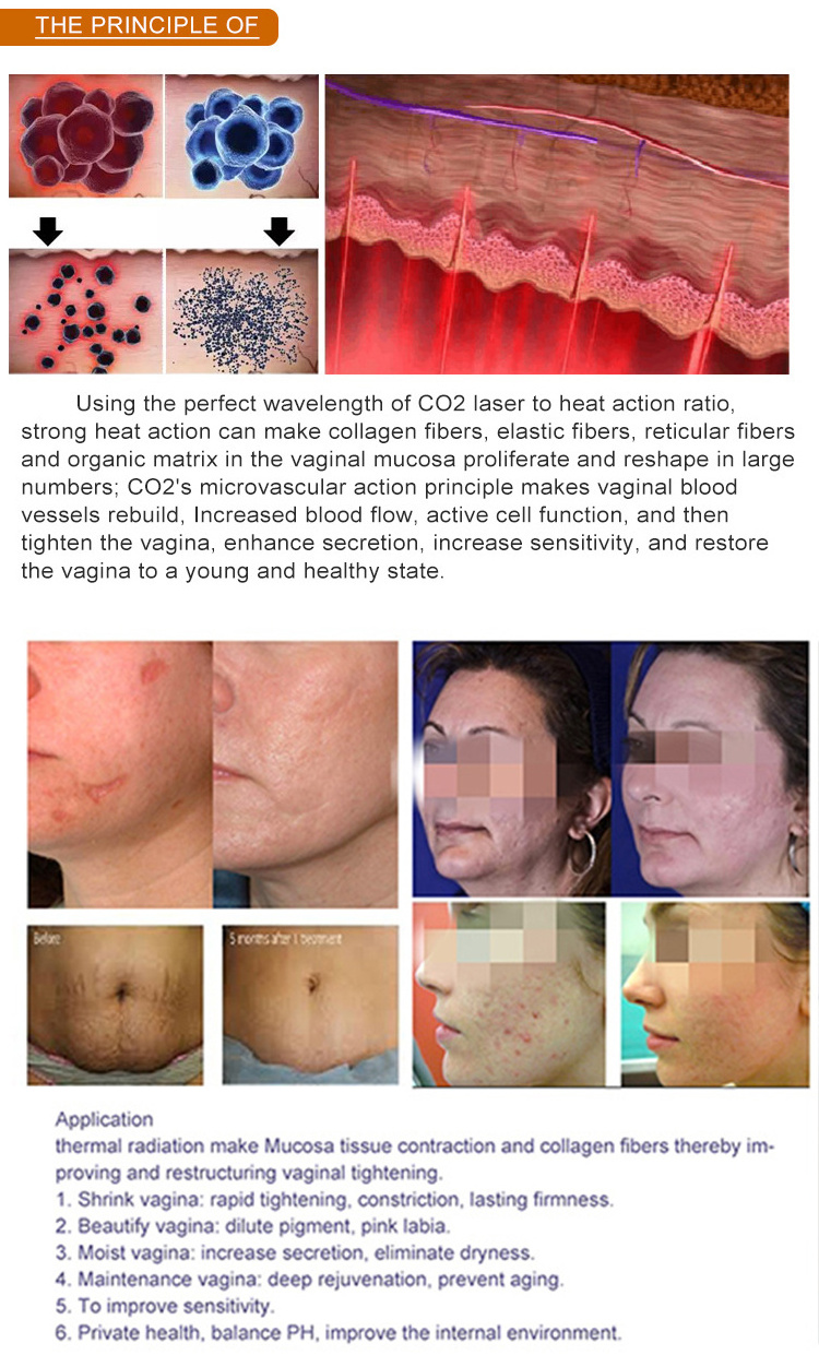 skin rejuvenation vaginal tightening laser co2 60w fraccionado