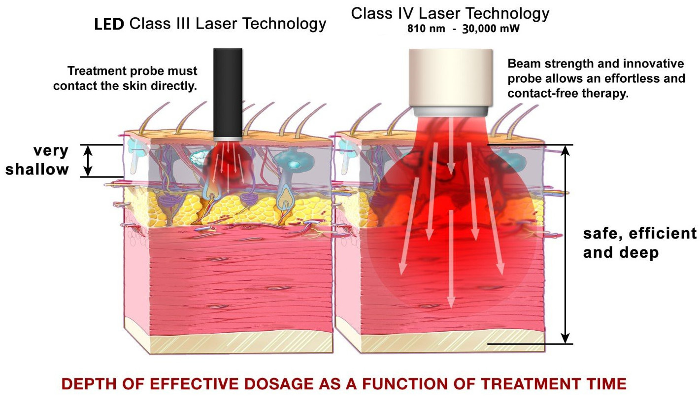 new technology 2022 high power laser red laser therapy class 4 physiotherapy laser