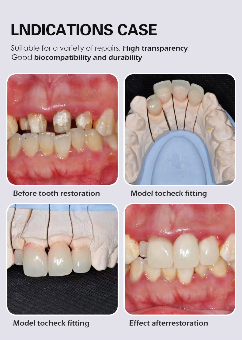 MIIYEN BAOT Resin Disc Temporary Crown Pmma Multilayer CAD CAM Milling Blank Acrylic Teeth Dental Pmma Block