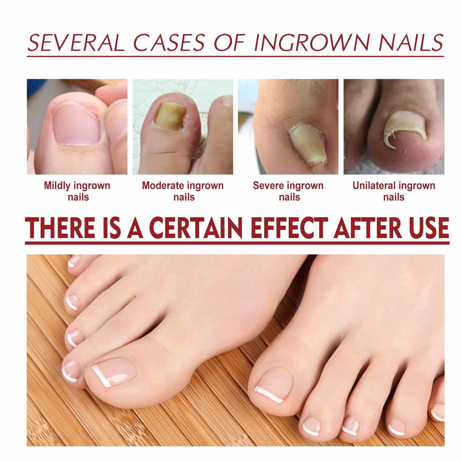 Soften Nail Anti Podiatry Paronychia Correction Professional Suppliers Relief Oil Repair Grey Hand Toenail Ingrown Essential Oil