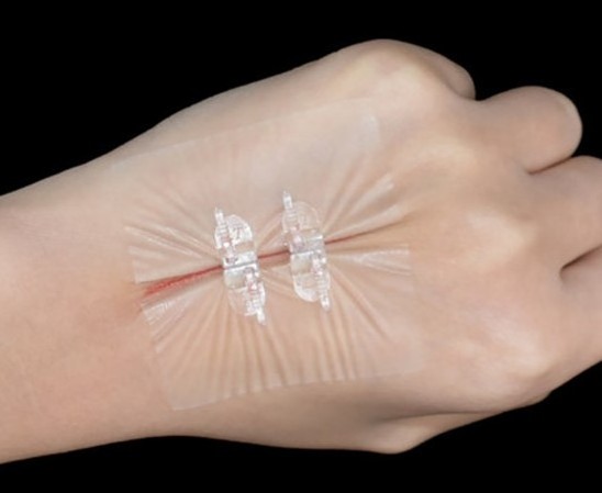 Suture-Free Medical devices Non-invasive Adhesive Wound Skin Closure Device