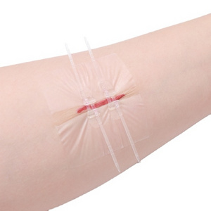 Suture-Free Medical devices Non-invasive Adhesive Wound Skin Closure Device