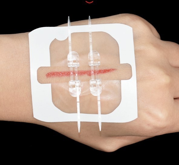 Suture-Free Medical devices Non-invasive Adhesive Wound Skin Closure Device