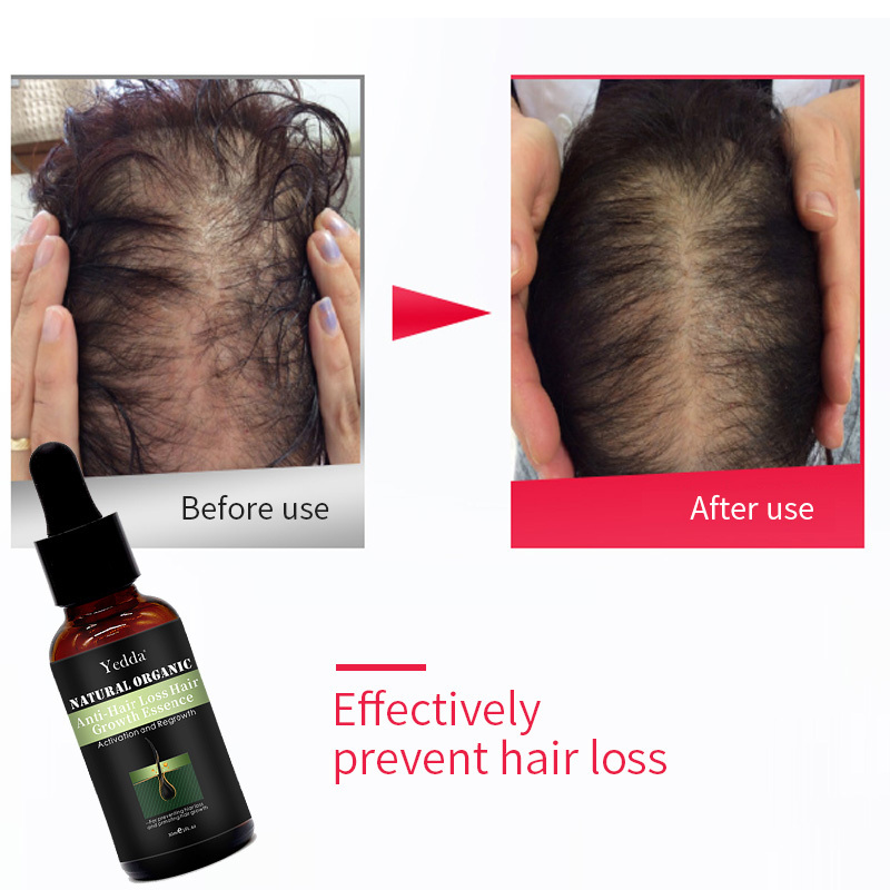 Hair Care Anti-Loss Treatment 30ml growth oil Hair Regrowth  For Men and Women Professional hair care products