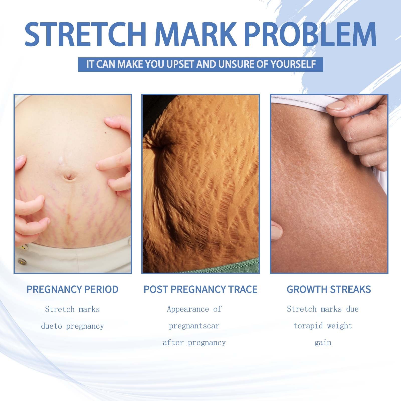 Jaysuing OEM ODM Pregnancy Marks Removal Body Stretch Mark Cream For Legs