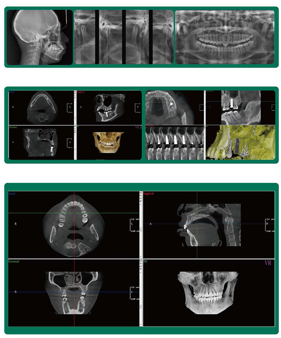 Dental Digital CBCT 3D Panoramic Dental Cephalometric X Ray Machine Digital Dental OPG Panoramic 3D X Ray Tomographic System