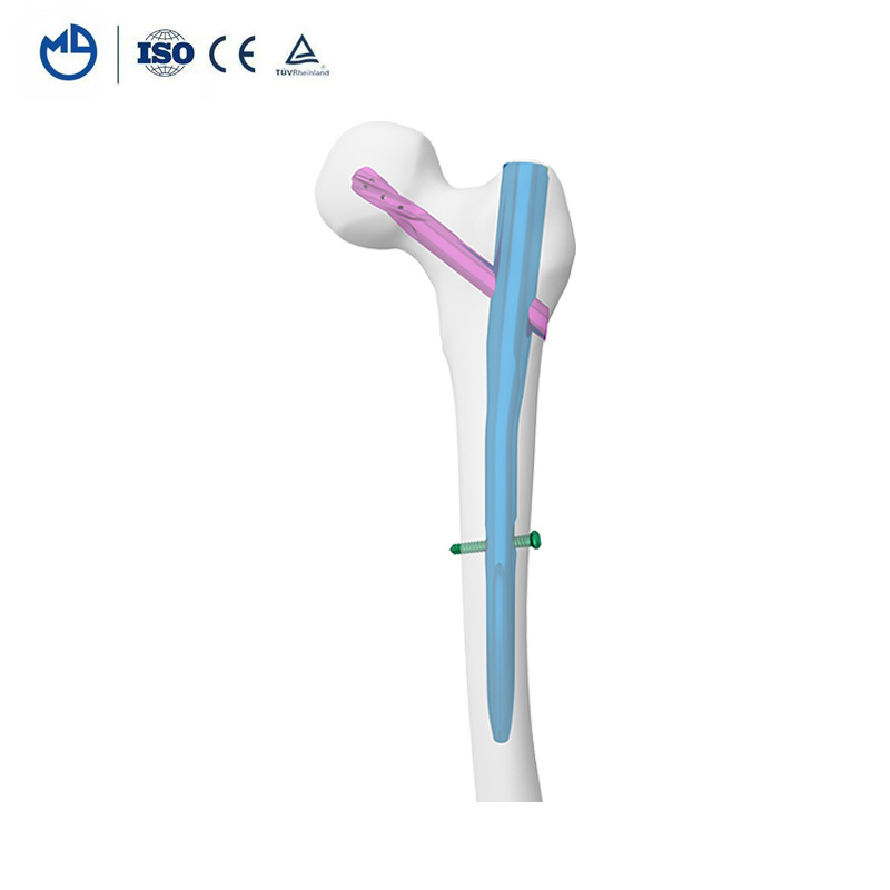 Antirotation Titanium Gamma Proximal Femoral Nail PFNA Orthopedic Implant Set, Clavo Medico Clou Pfn Tibia Intramedullary Nail//