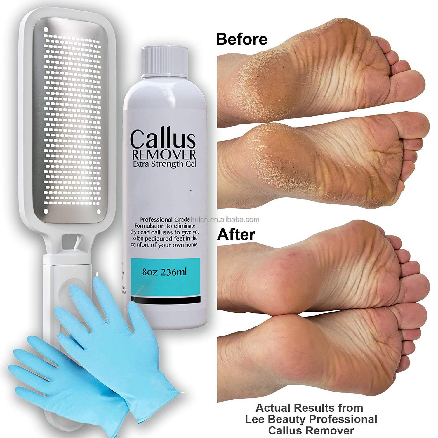 Professional Callus Remover Extra Strength Gel And Foot Rasp Spa Kit