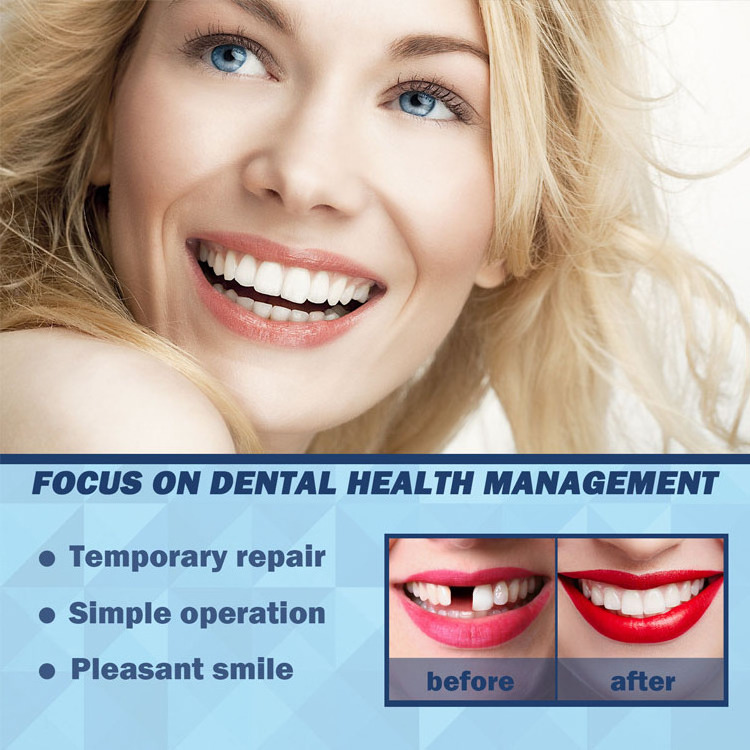 OUHOE Teeth Whitening Temporary Filling Teeth Repair Broken Tooth Gaps Repair Glue Teeth resin repair filling material