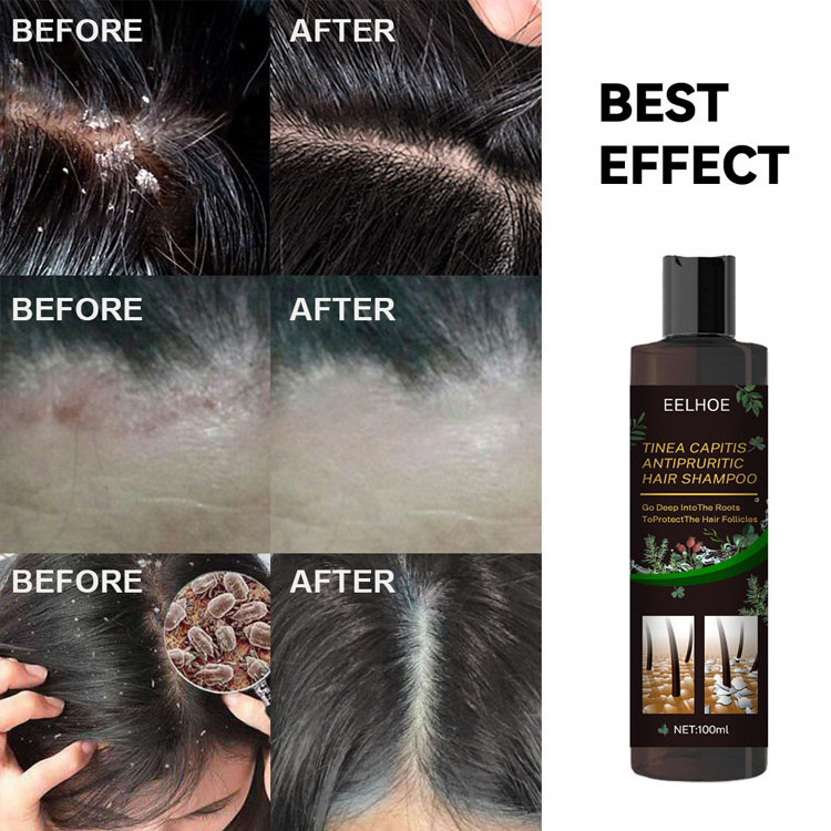 EELHOE New Professional Anti-Dandruff Remove Mites and Relieve Itching Tina Capitis Antipruritic Hair Shampoo