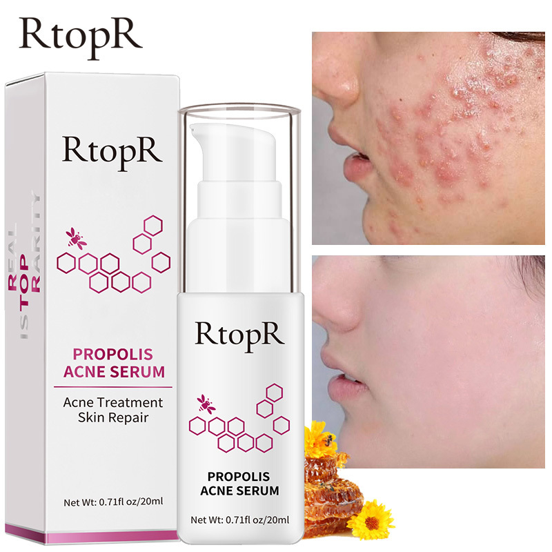 RtopR Official Store Propolis Acne Serum Repair Acne Brightening Serum Scar Spots Cleaning Serum Shrink Pores Acne Treatment