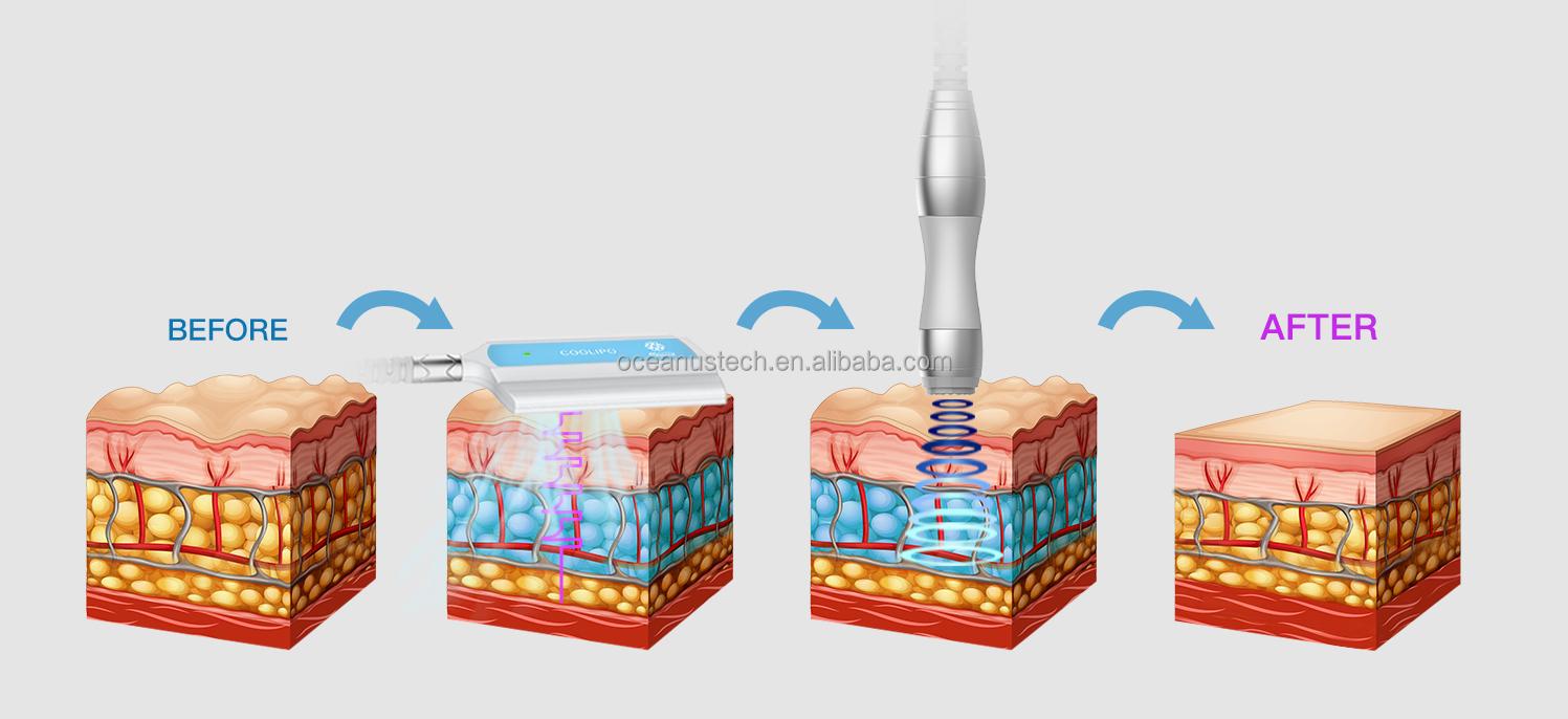 Newest Technology Body Contouring Cool Thermal Paddles Cryoskin EMS Shockwave Machine