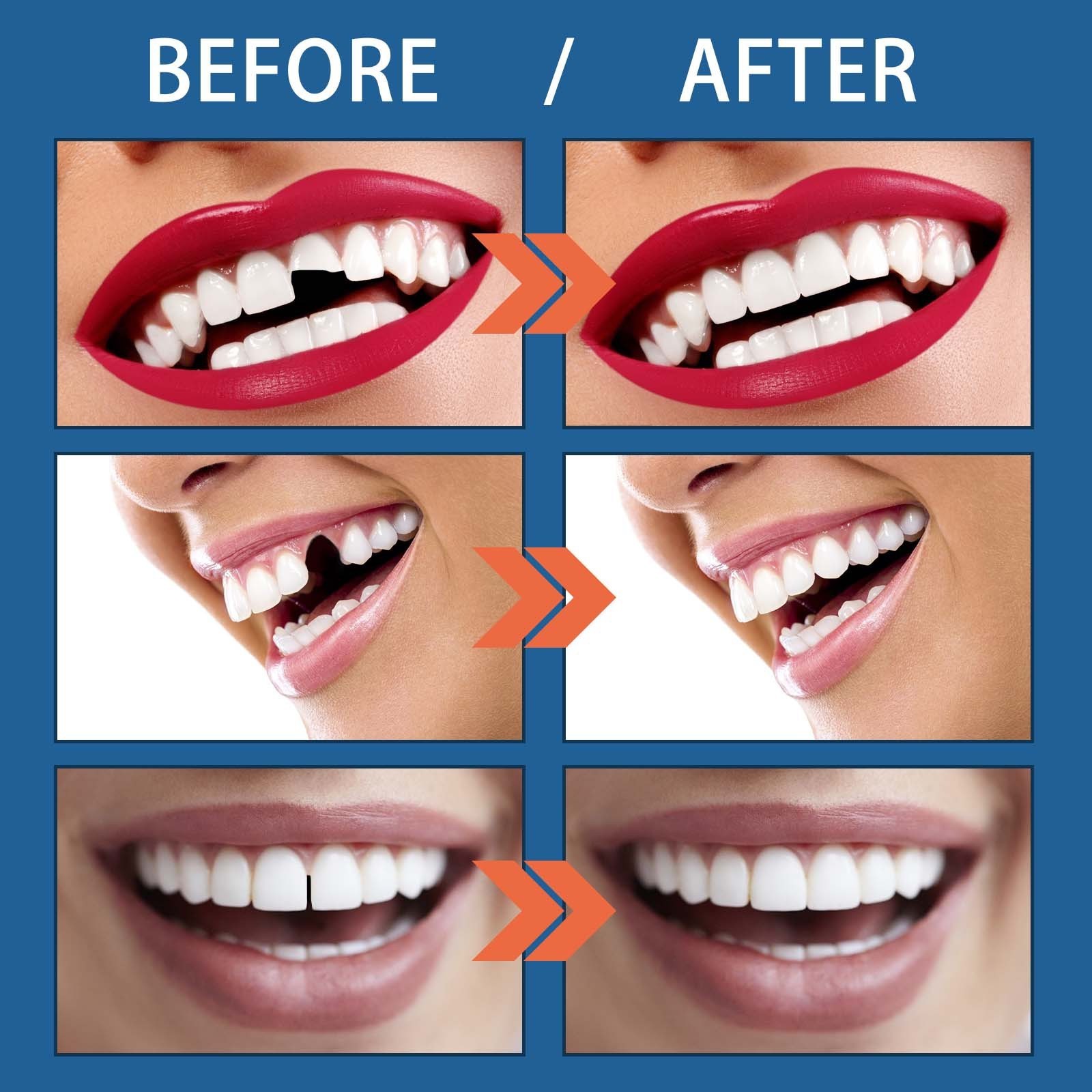 Temporary missing broken tooth repair granules teeth gaps tooth false teeth filling moldable solid glue