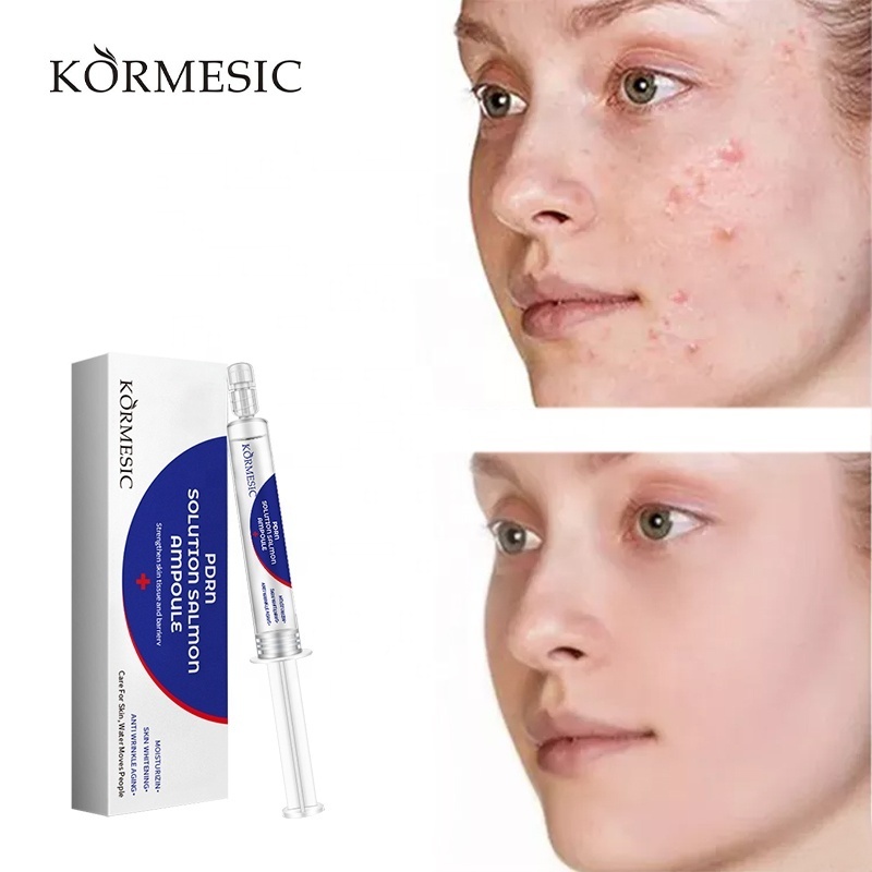 KORMESIC Nourishing and formula Skin Lotion Face Acne Scar Pimples Dark Spot Remover Anti Acne