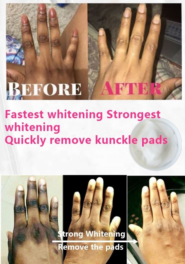 Fastest Bleaching Body Peeling Lotion Knuckles Removing Dead Skin Whitening Lotion  Body Knuckles Beauty Bleaching Cream