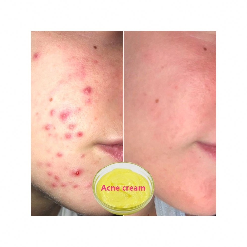 Customize Acne Scar Erase Cream Bio Aqua Acne Cream Sold By Weight