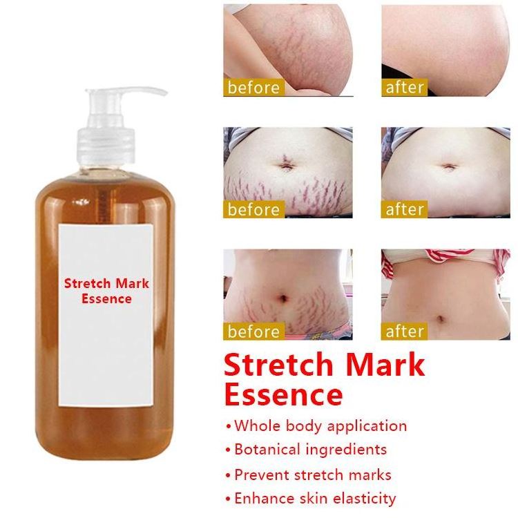 Hot Sell OEM 100% Natural Organic Vegan Body Care Deep Acne Scar Anti Stretch Mark Removal Cream