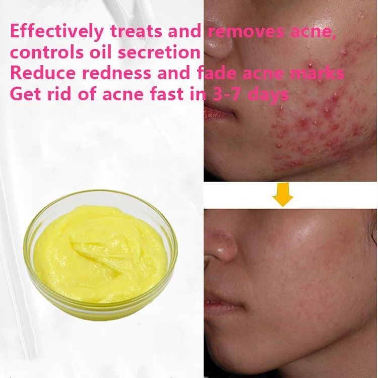 Customize Acne Scar Erase Cream Bio Aqua Acne Cream Sold By Weight