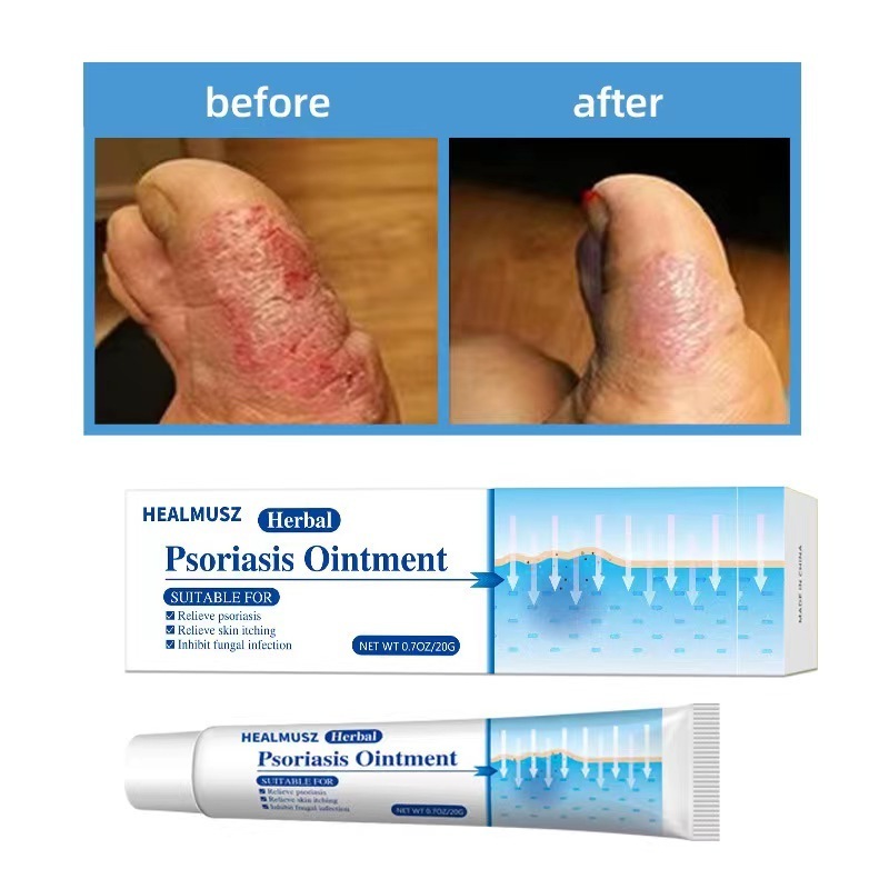 Eczema Psoriasis Cream External Use Dermatitis Ointment Herbal Cream Anti Itch Plaster