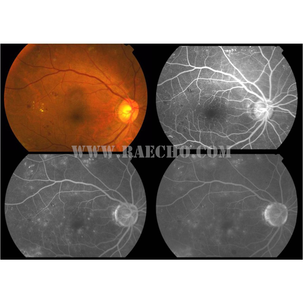 Fully Auto New Design Advanced Digital Fundus Camera