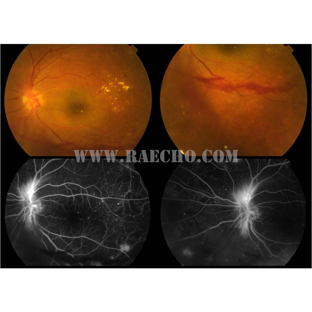 Fully Auto New Design Advanced Digital Fundus Camera