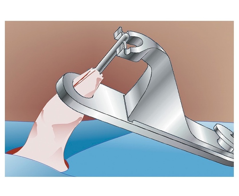 Gumco Circumcision Clamp OEM Stainless Steel Gomco Circumcision Clamp OB/Gynecology Urology Instrument