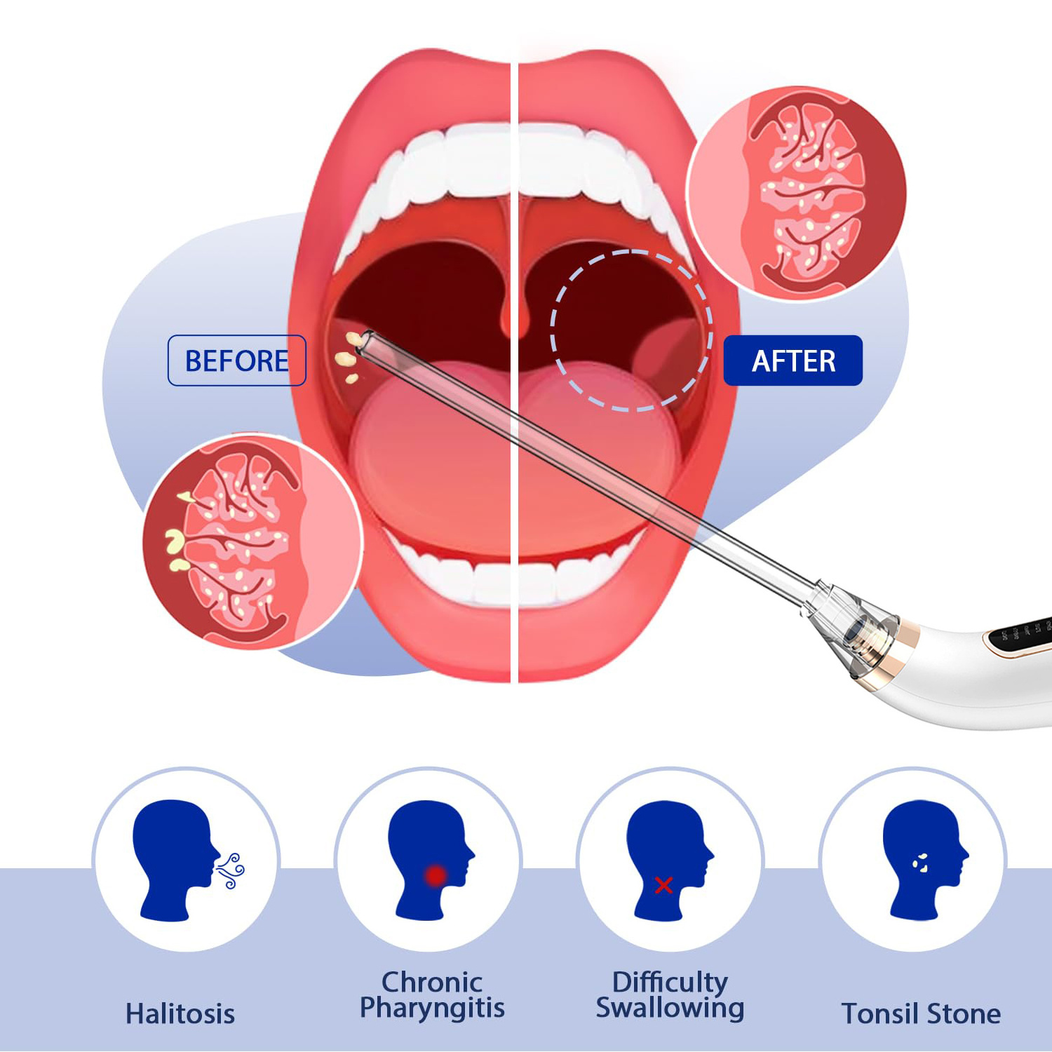 Personal Care Electronic Tonsil Stone Remover Vacuum Stone Removal Kit Instant Suction Tools