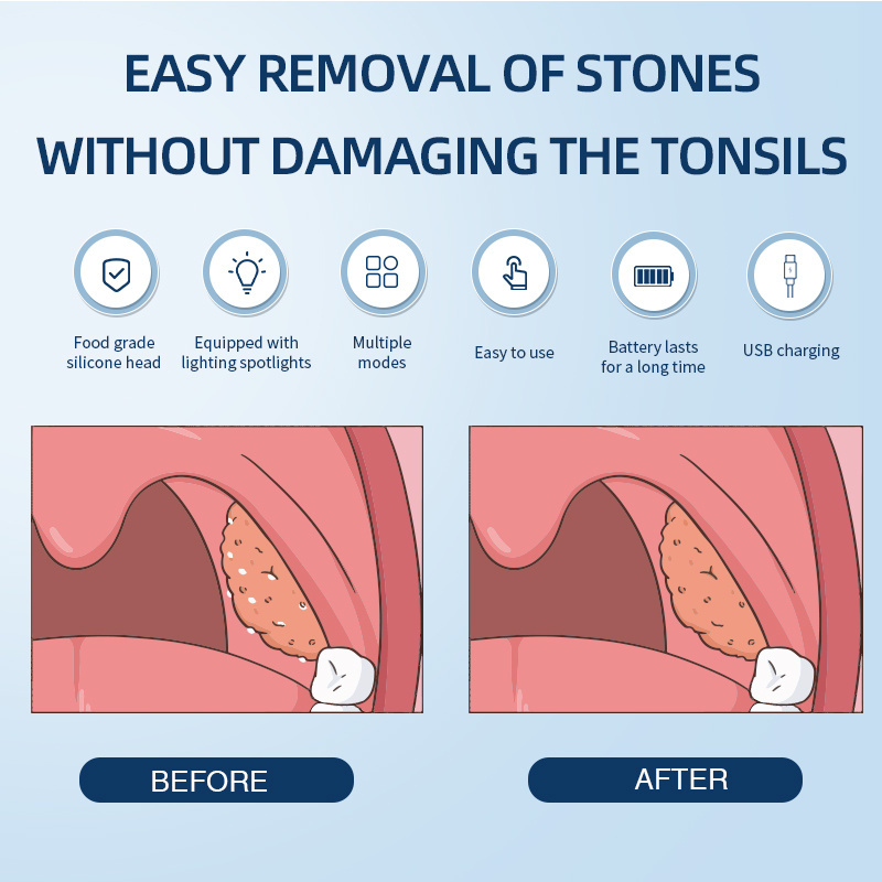 Customized Portable Vacuum Suction Stone Removal kit Food grade silicone head Electronic Tonsil Stone Remover