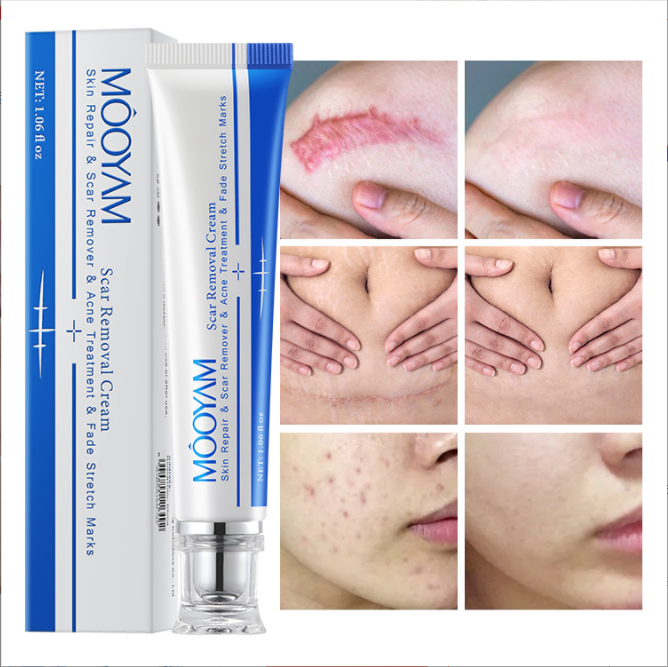 Strong Effective Acne Scar Removal Cream Pimples Stretch Marks Face Gel Tummy Tuck Tightening Stretch Mark Removal Cream