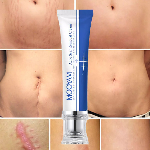 Strong Effective Acne Scar Removal Cream Pimples Stretch Marks Face Gel Tummy Tuck Tightening Stretch Mark Removal Cream