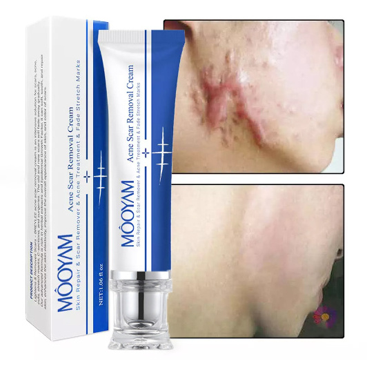 Strong Effective Acne Scar Removal Cream Pimples Stretch Marks Face Gel Tummy Tuck Tightening Stretch Mark Removal Cream