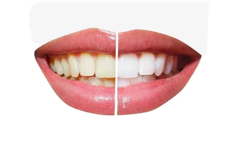 In Stock Thin Nano Smile Pop Porcelain Composite Restore The Normal Shape Of Clip On Tooth Veneer