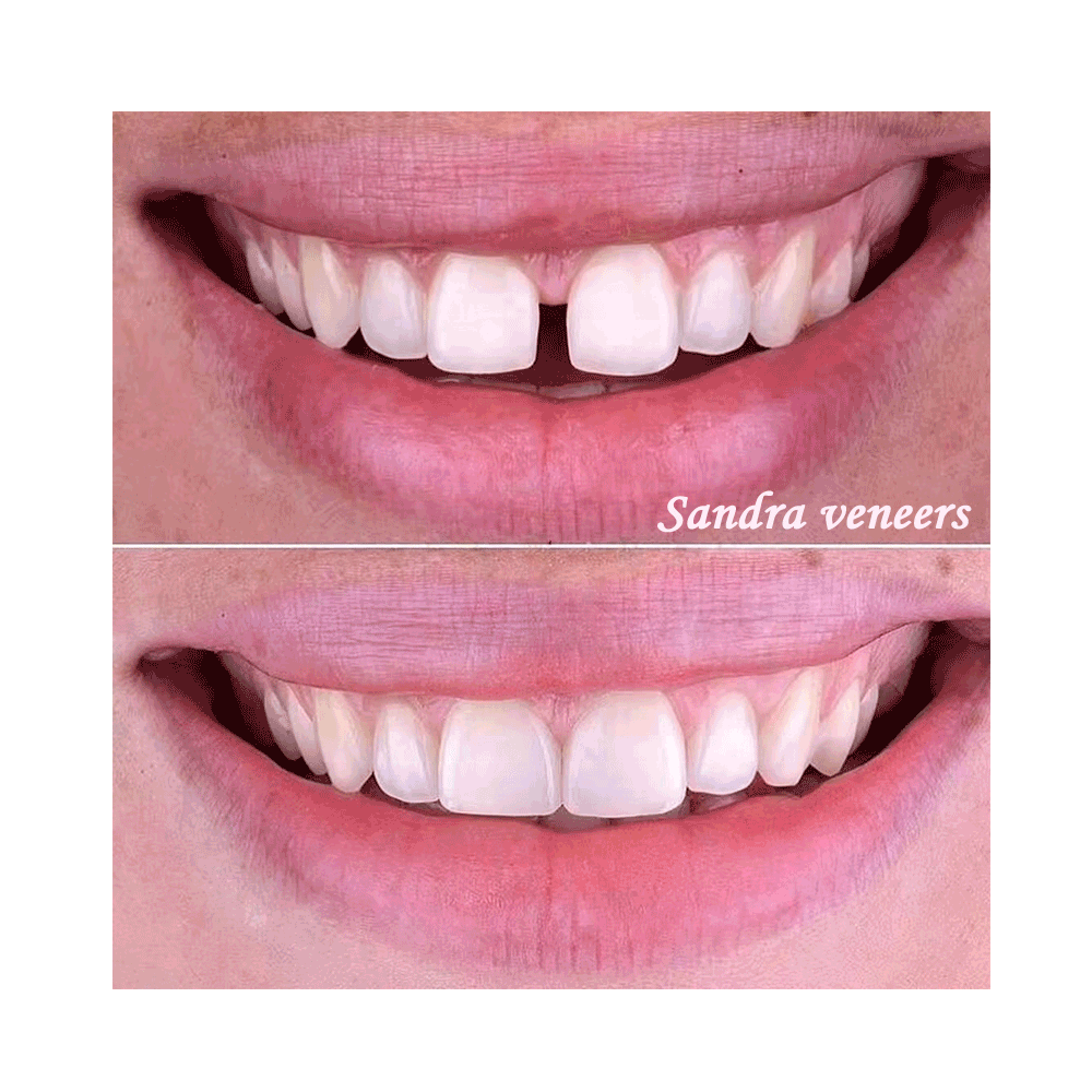 In Stock Thin Nano Smile Pop Porcelain Composite Restore The Normal Shape Of Clip On Tooth Veneer