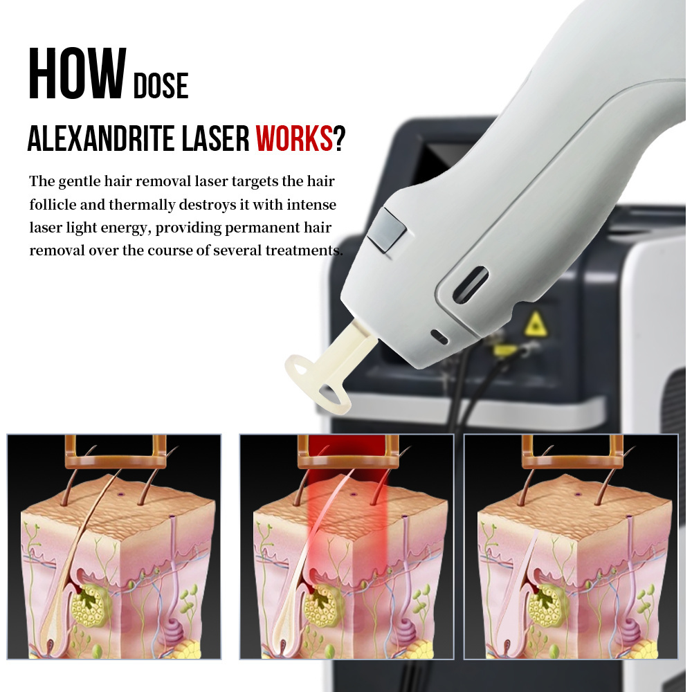 Newest Alexandrite Laser Hair Removal long pulse 1064nm Nd Yag 755nm Alexandrite Alex Laser Hair Removal Machine