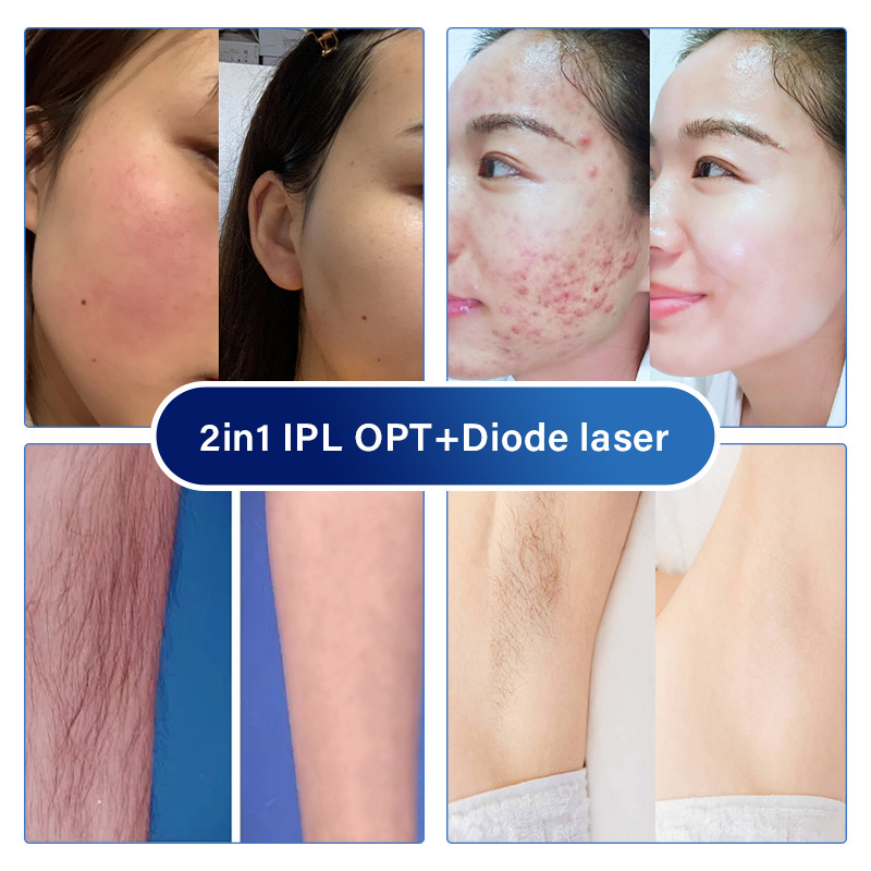 e light ipl dpl rf handle laser professional portable skin rejuvenation hair removal machines