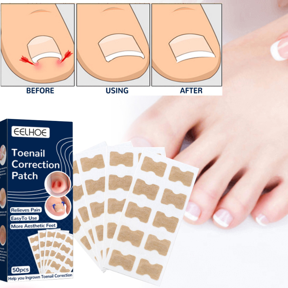 S-King Man And Women Toenail correction stick nail correction stick nail inlay correction repair patch repair toe inlay